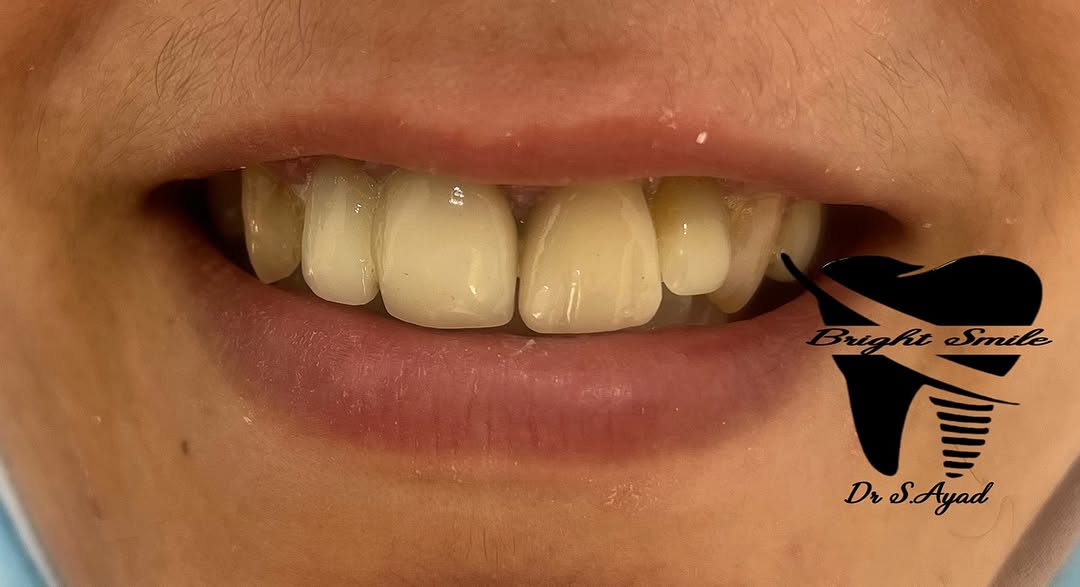 Bright Smile Dental Clinic - Résultat de traitement